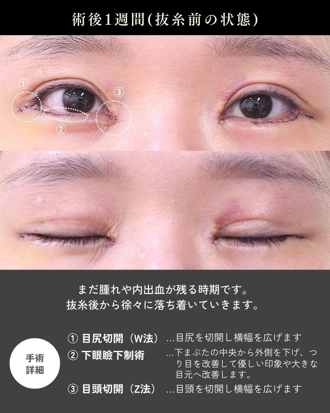 目を大きく見せたいというご希望で、