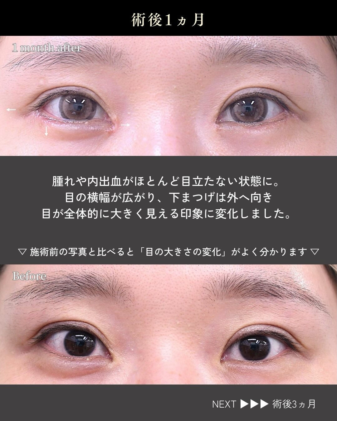 目を大きく見せたいというご希望で、