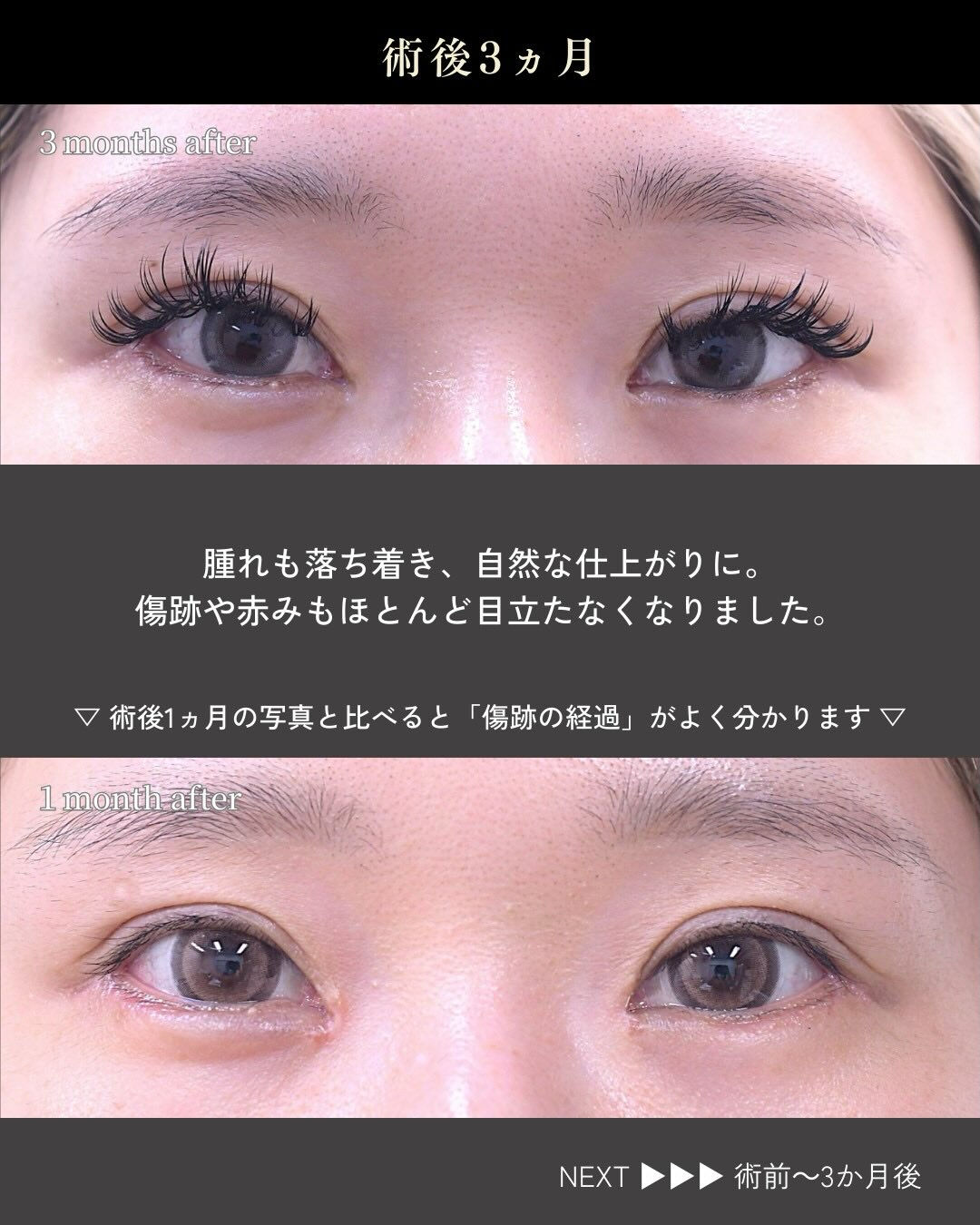 目を大きく見せたいというご希望で、
