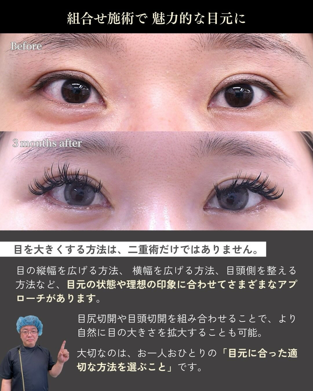 目を大きく見せたいというご希望で、