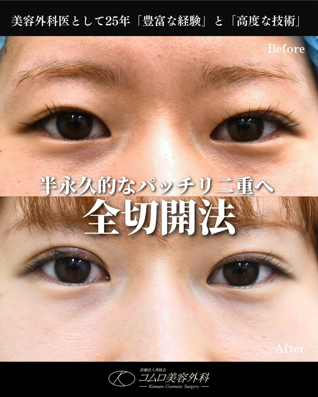 埋没法をしたけれど・・