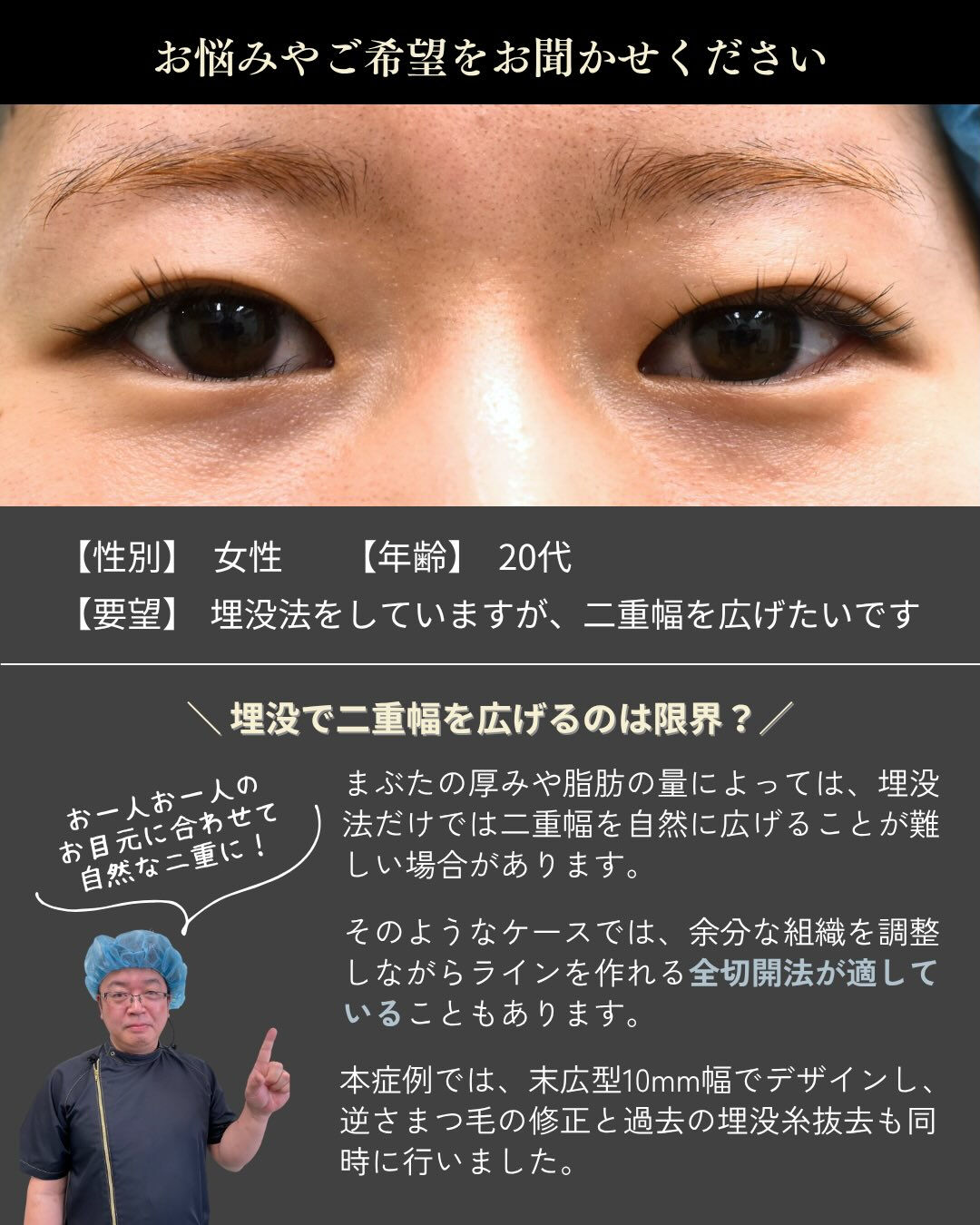 埋没法をしたけれど・・