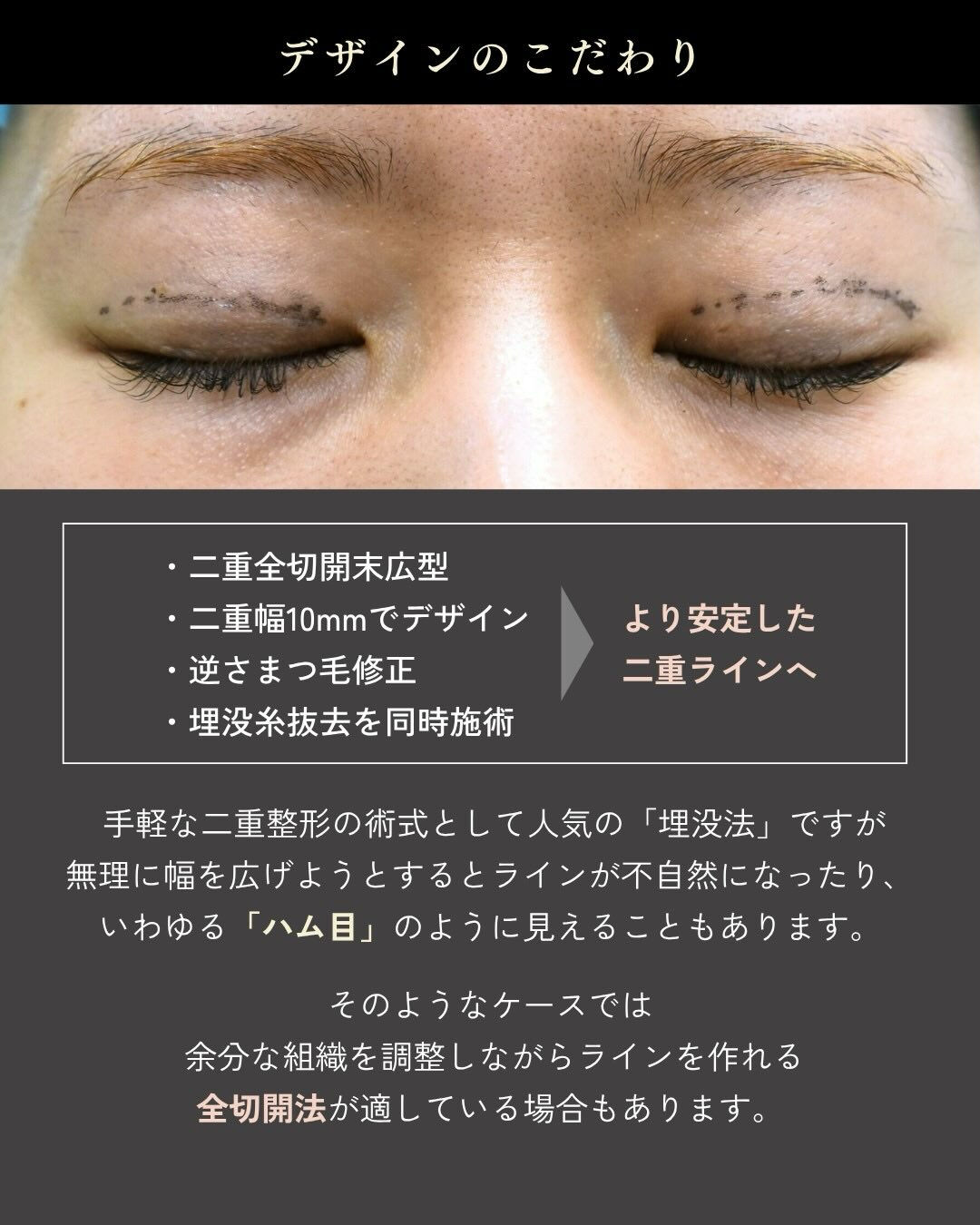 埋没法をしたけれど・・