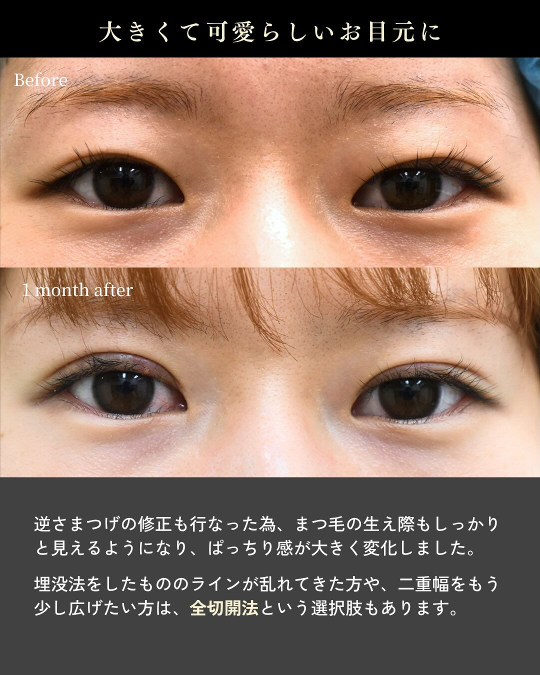 埋没法をしたけれど・・
