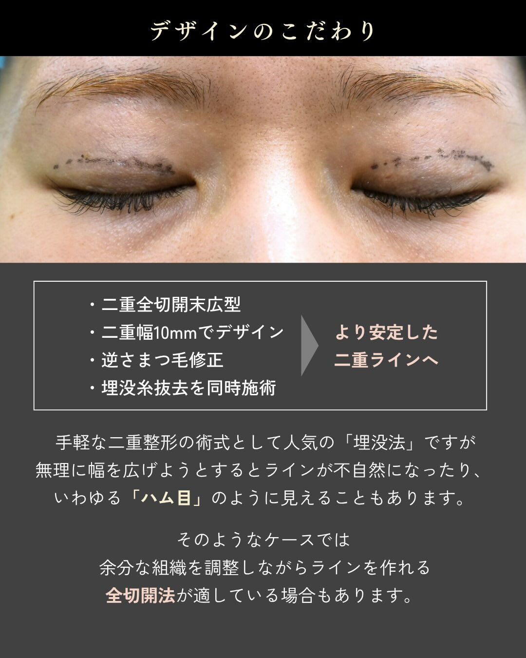 埋没法をしたけれど