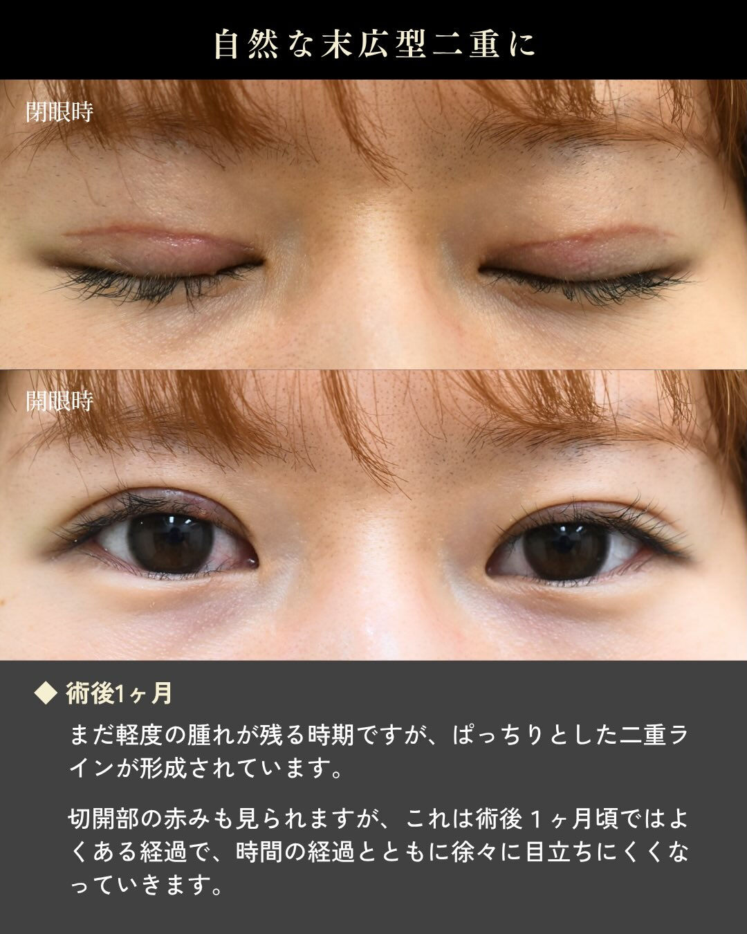 埋没法をしたけれど