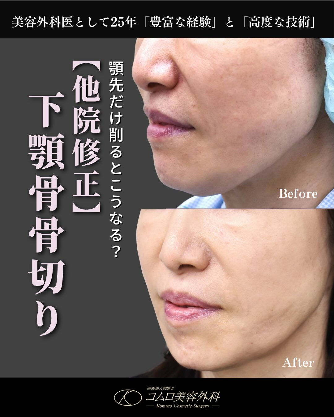 【他院術後の輪郭修正症例】