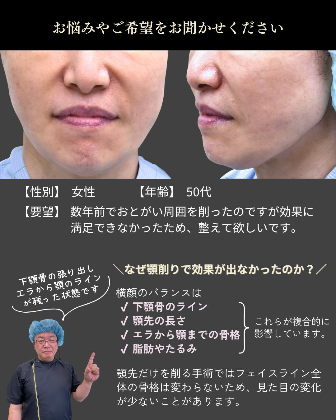 【他院術後の輪郭修正症例】