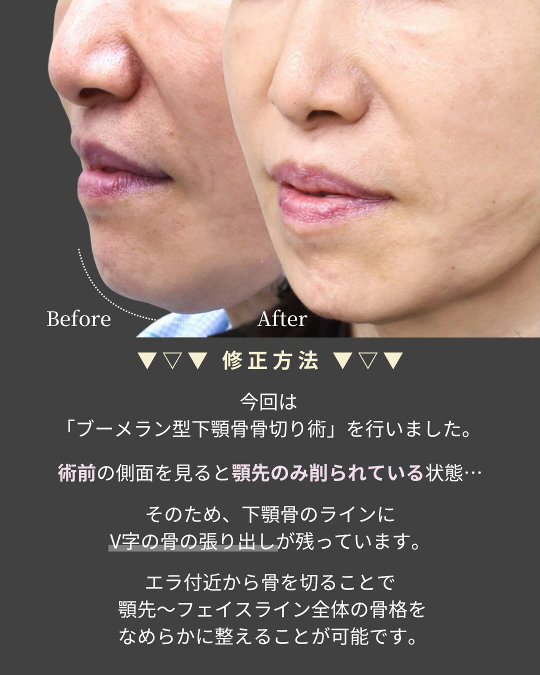 【他院術後の輪郭修正症例】
