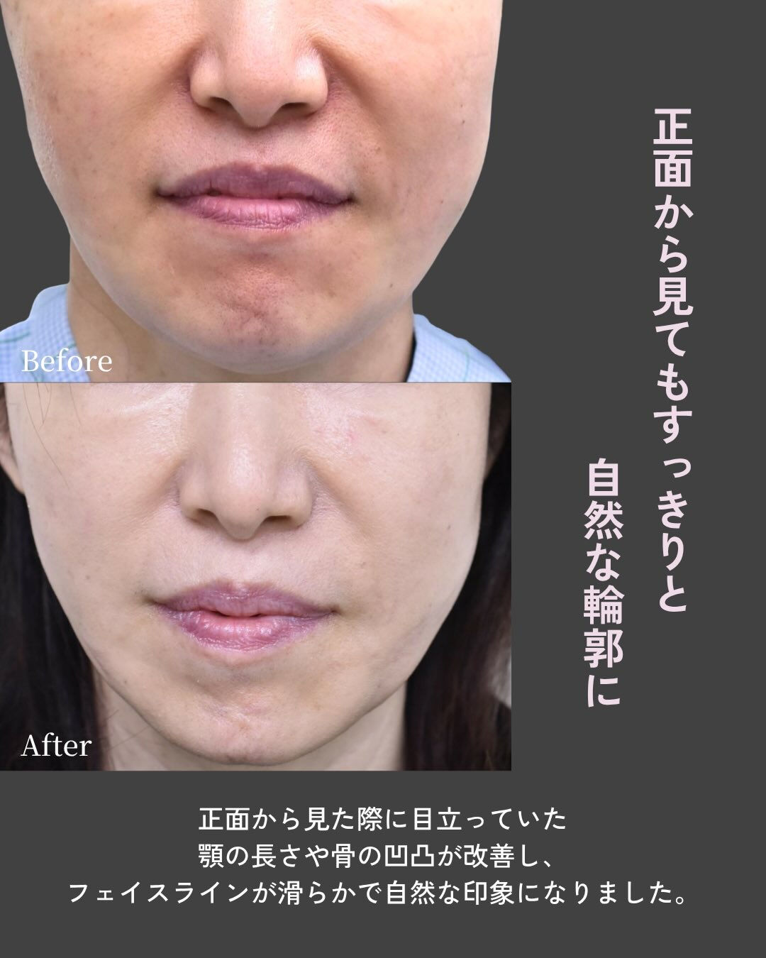 【他院術後の輪郭修正症例】