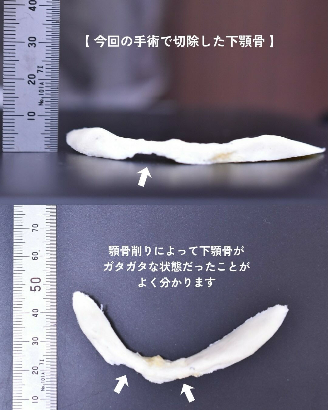 【他院術後の輪郭修正症例】