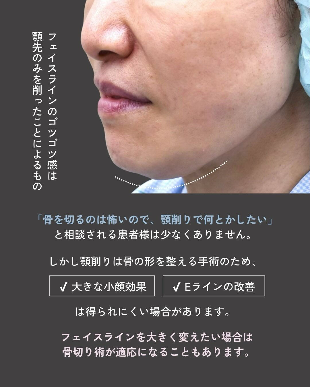 【他院術後の輪郭修正症例】