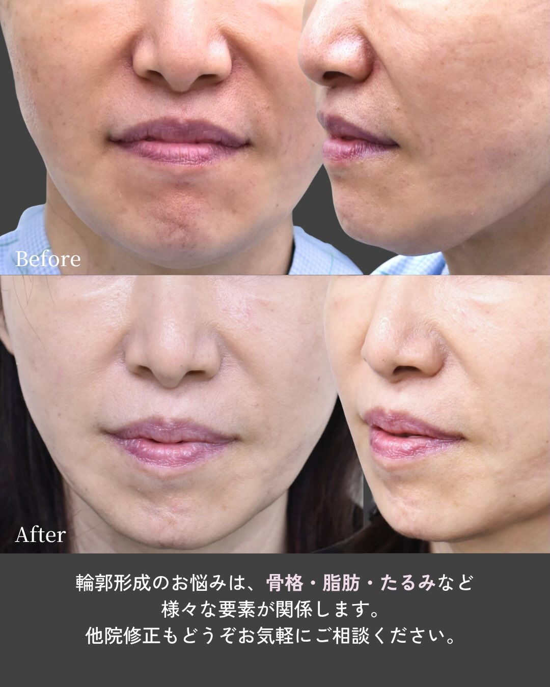 【他院術後の輪郭修正症例】
