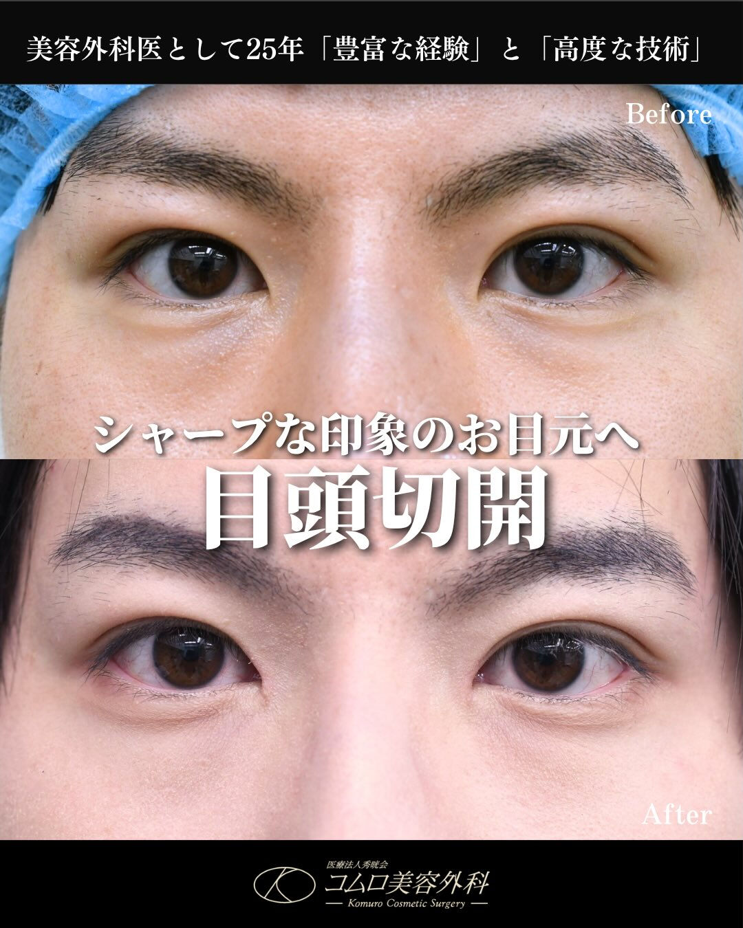 【目頭切開症例】