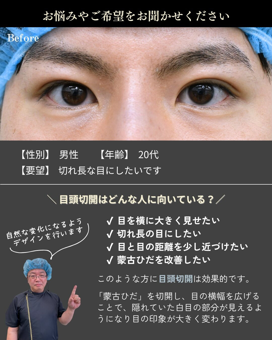 【目頭切開症例】