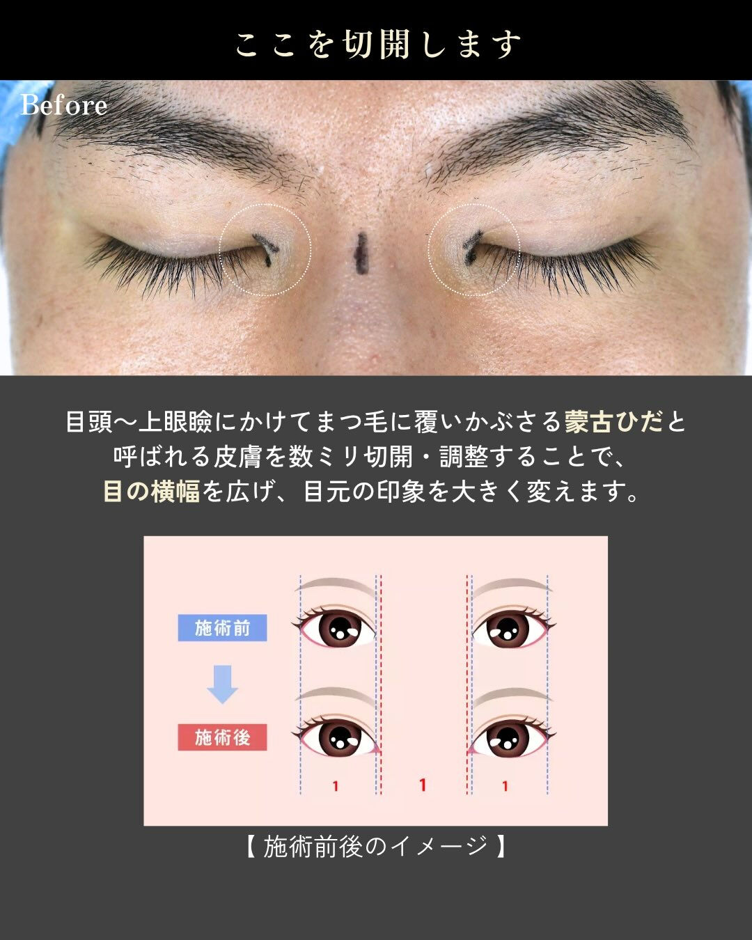【目頭切開症例】