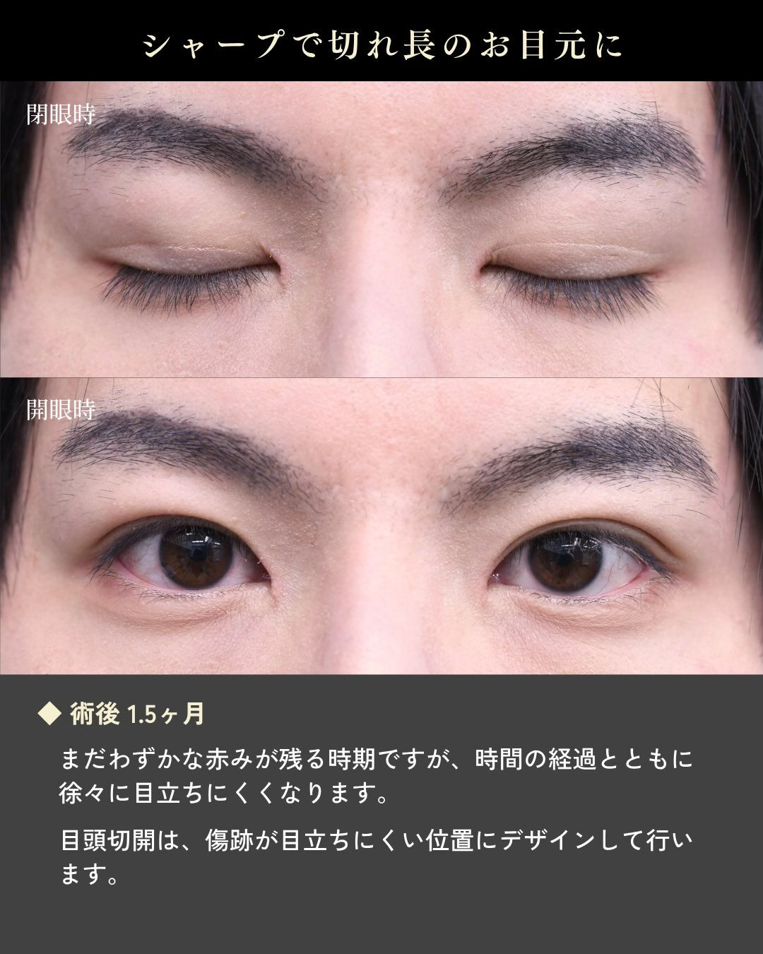 【目頭切開症例】