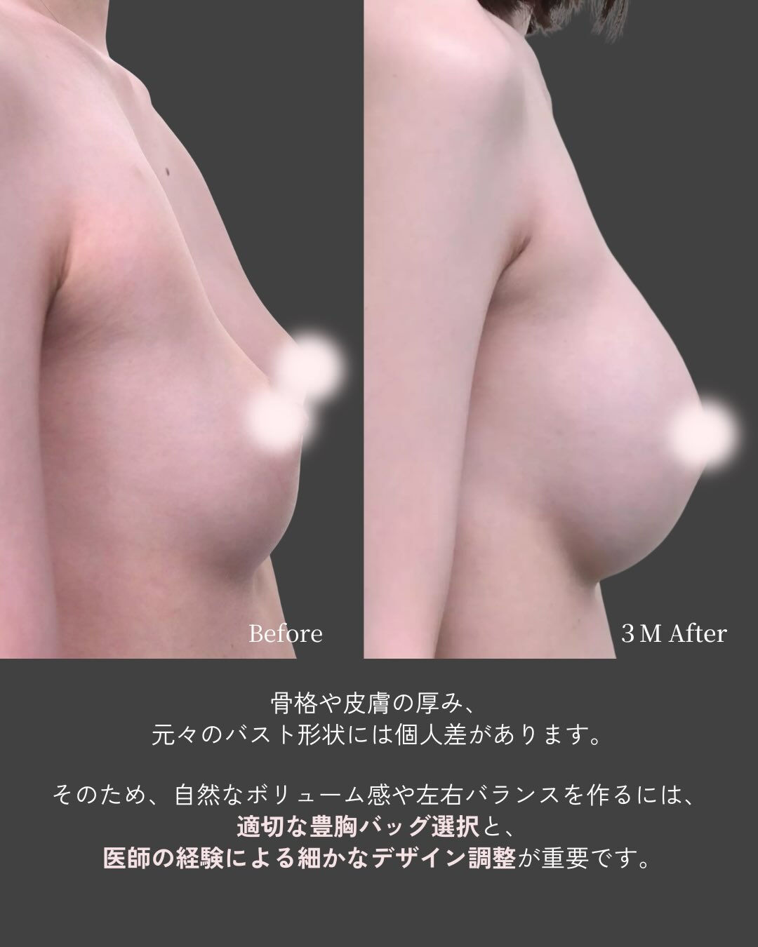 【モティバ豊胸術 症例】