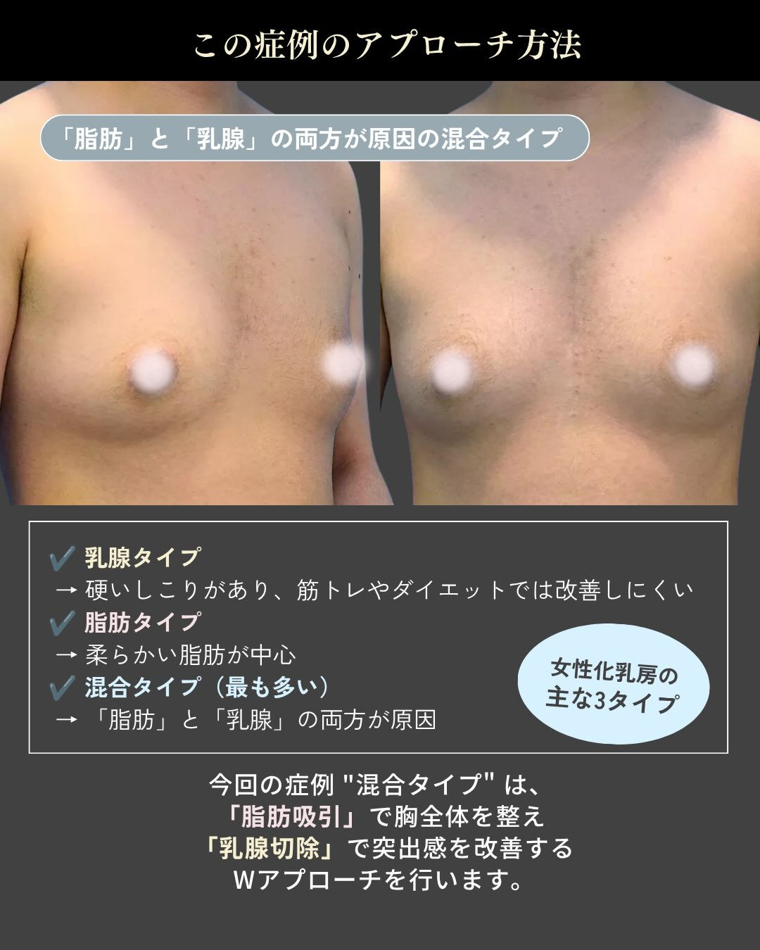 「痩せても胸だけ残る…」