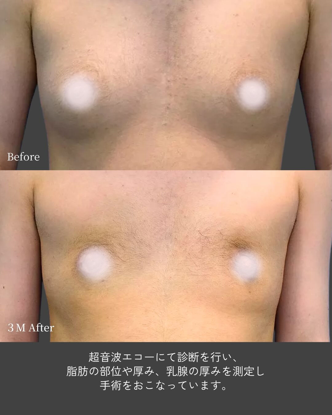 「痩せても胸だけ残る…」