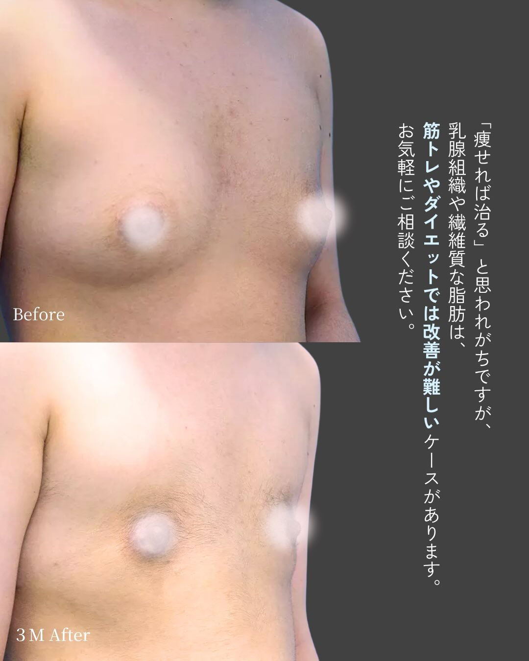 「痩せても胸だけ残る…」