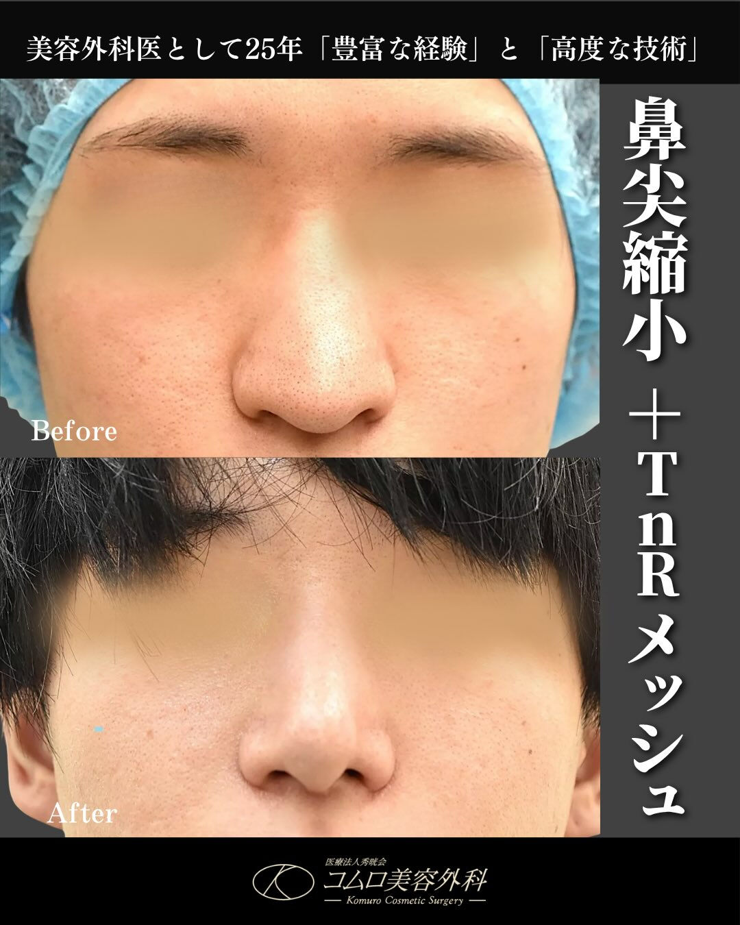 【鼻尖縮小＋TnRメッシュ症例】