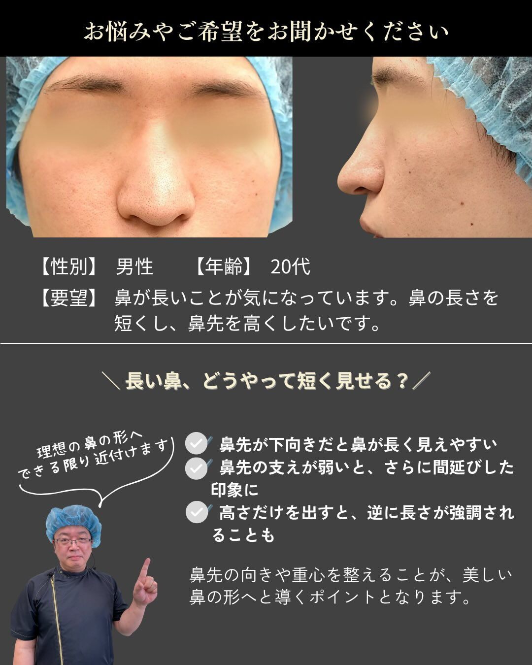 【鼻尖縮小＋TnRメッシュ症例】