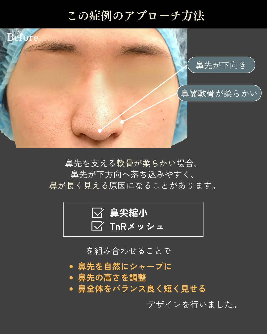 【鼻尖縮小＋TnRメッシュ症例】