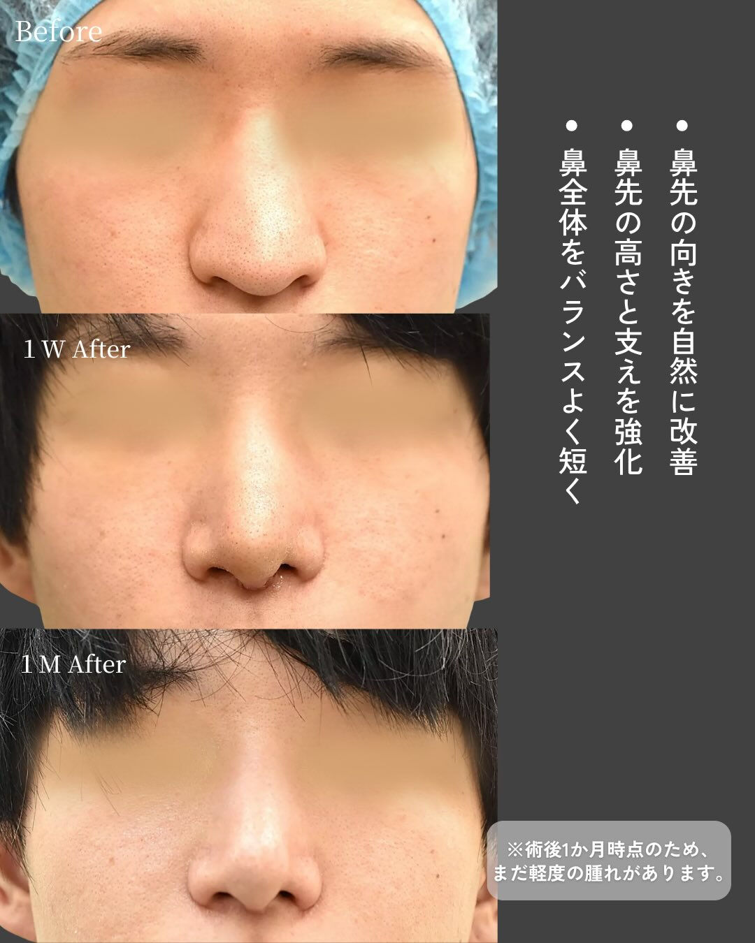 【鼻尖縮小＋TnRメッシュ症例】