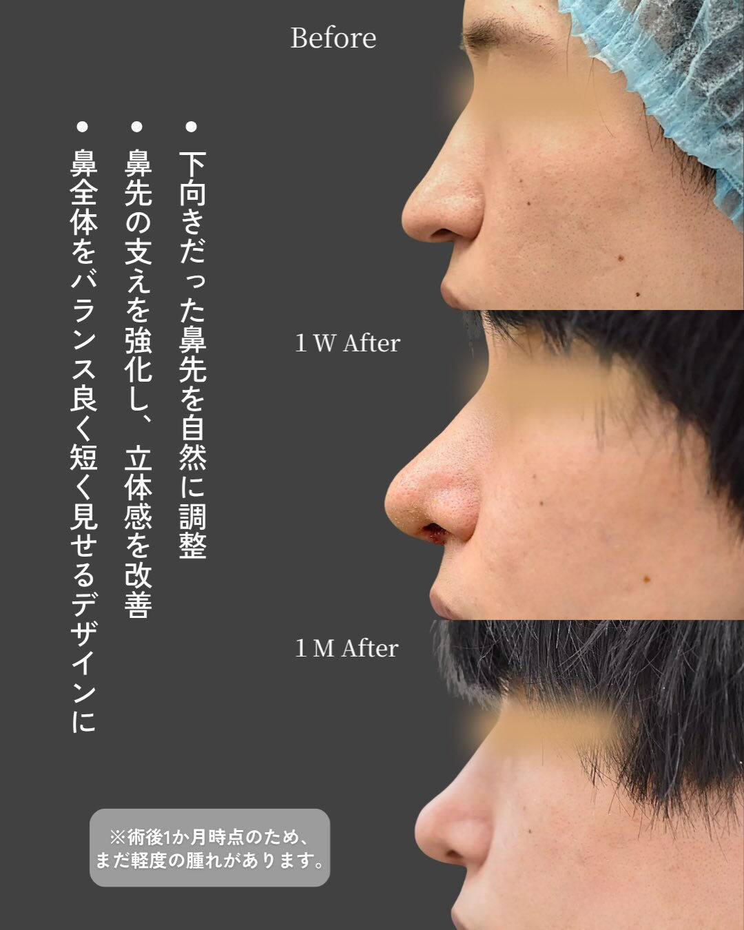 【鼻尖縮小＋TnRメッシュ症例】