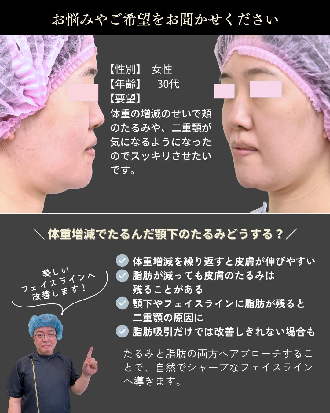 【フェイスリフト＋頬・顎下脂肪吸引症例】