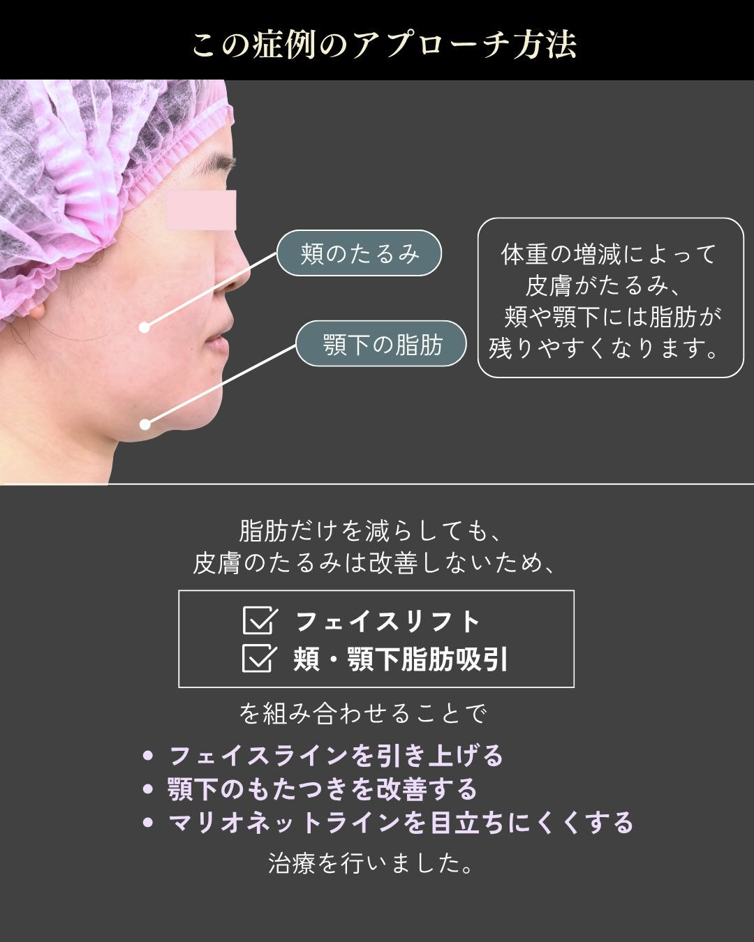 【フェイスリフト＋頬・顎下脂肪吸引症例】