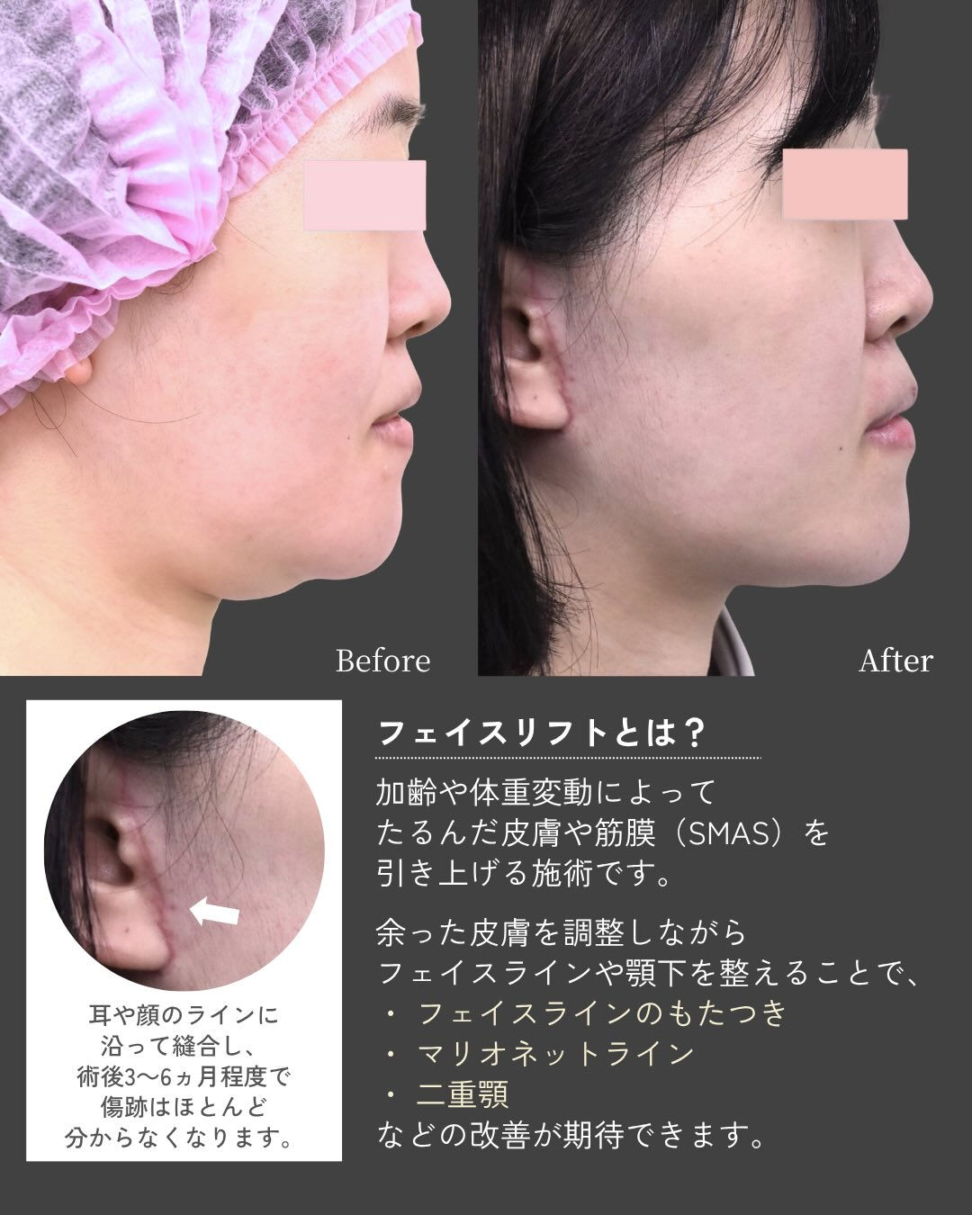 【フェイスリフト＋頬・顎下脂肪吸引症例】