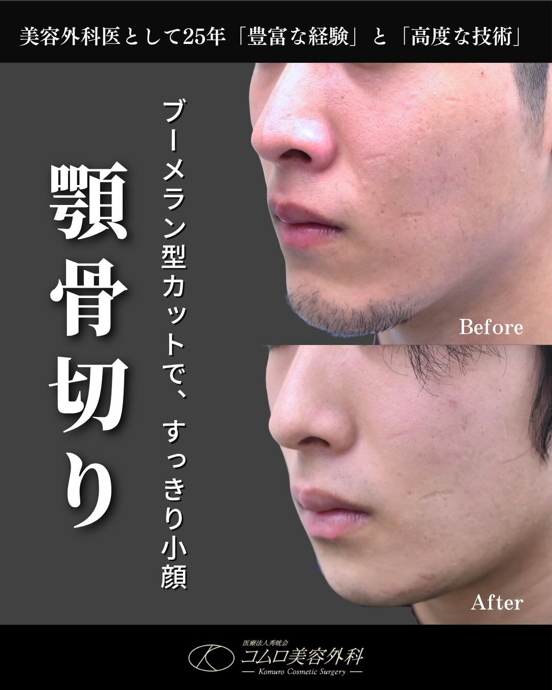 【20代男性／顎骨切り（ブーメラン型骨切り）症例】