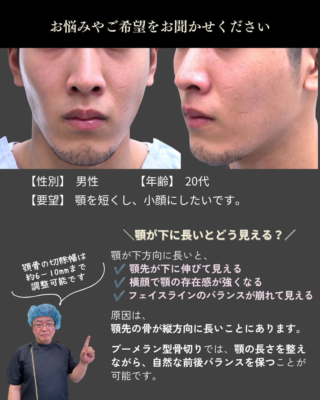 【20代男性／顎骨切り（ブーメラン型骨切り）症例】