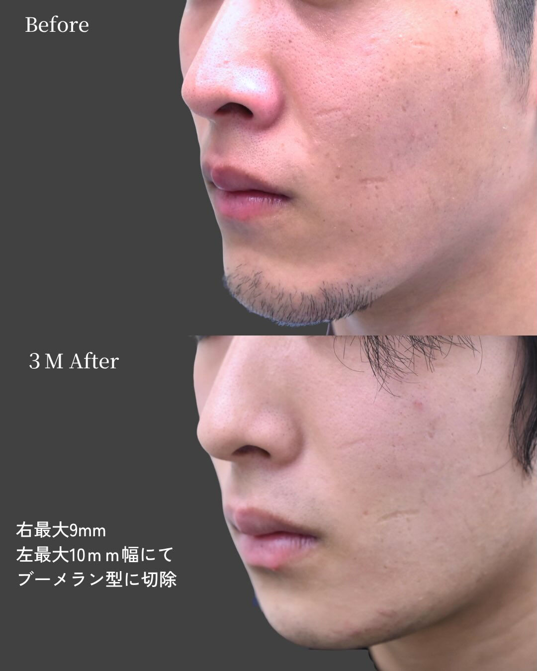 【20代男性／顎骨切り（ブーメラン型骨切り）症例】