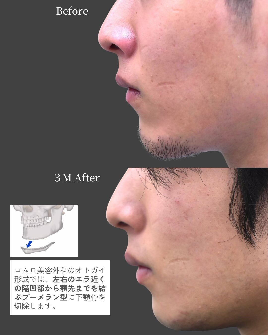 【20代男性／顎骨切り（ブーメラン型骨切り）症例】