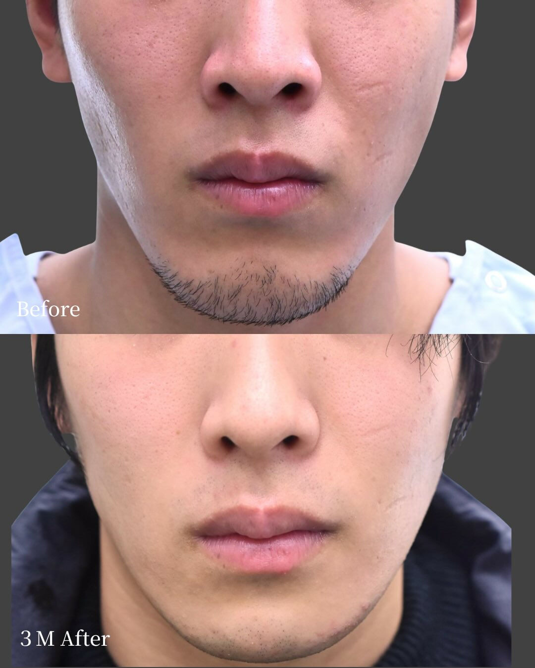 【20代男性／顎骨切り（ブーメラン型骨切り）症例】