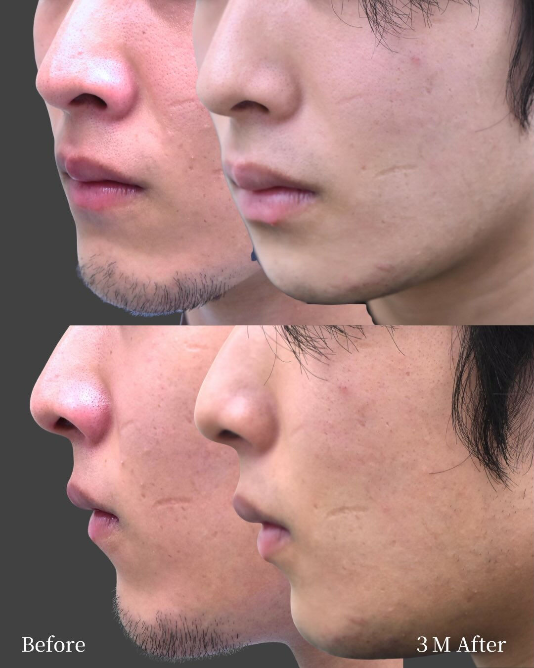 【20代男性／顎骨切り（ブーメラン型骨切り）症例】