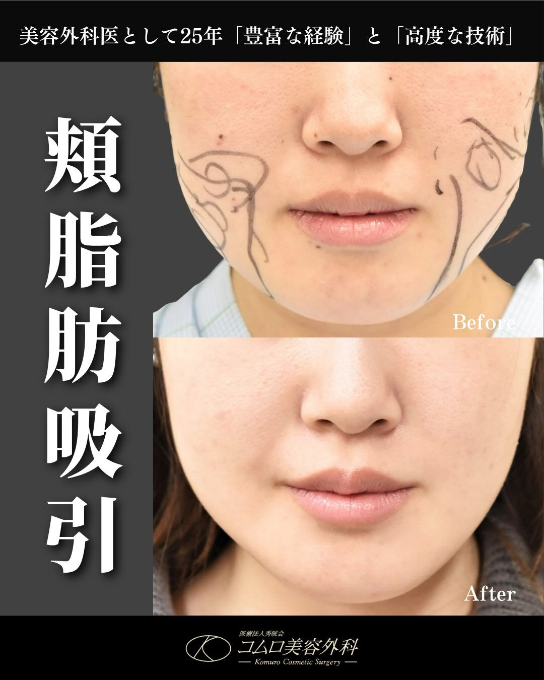 【頬脂肪吸引 症例紹介】