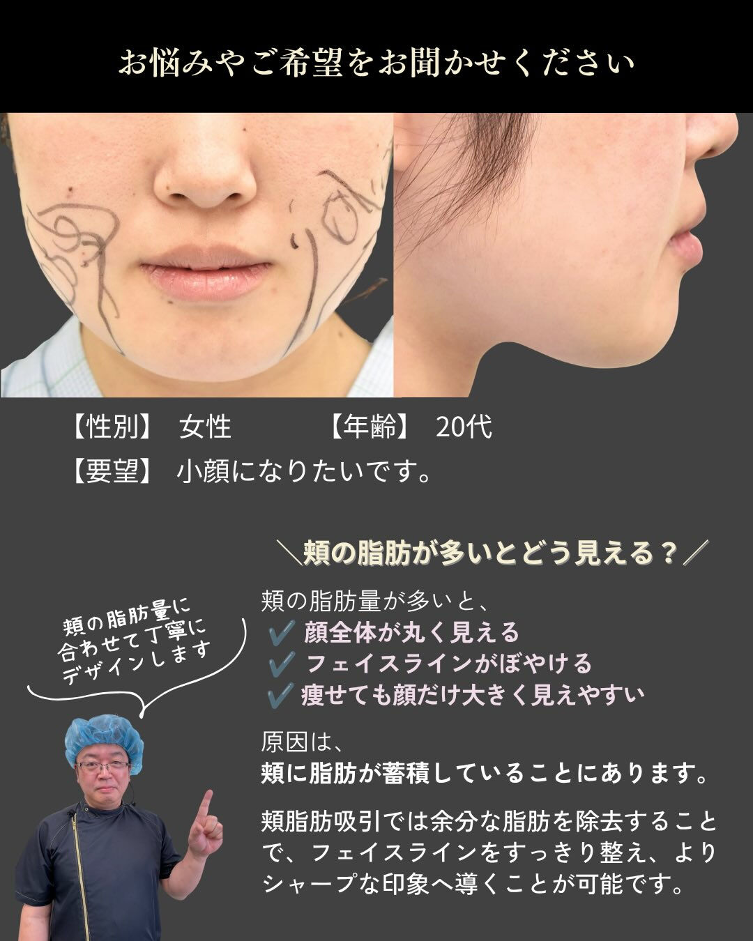 【頬脂肪吸引 症例紹介】