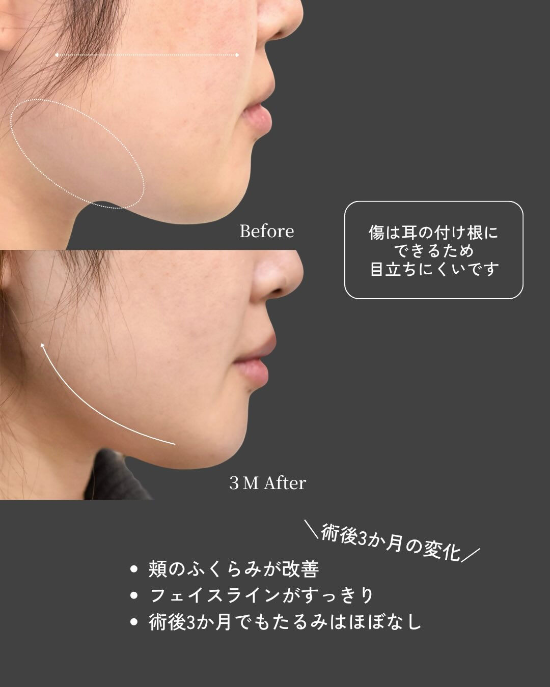 【頬脂肪吸引 症例紹介】