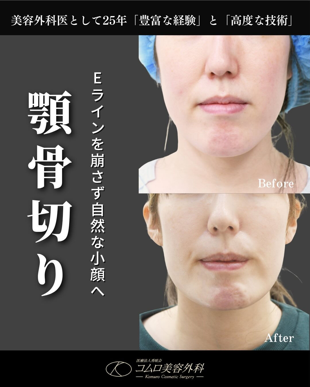 【下顎骨ブーメラン骨切り術 症例紹介】