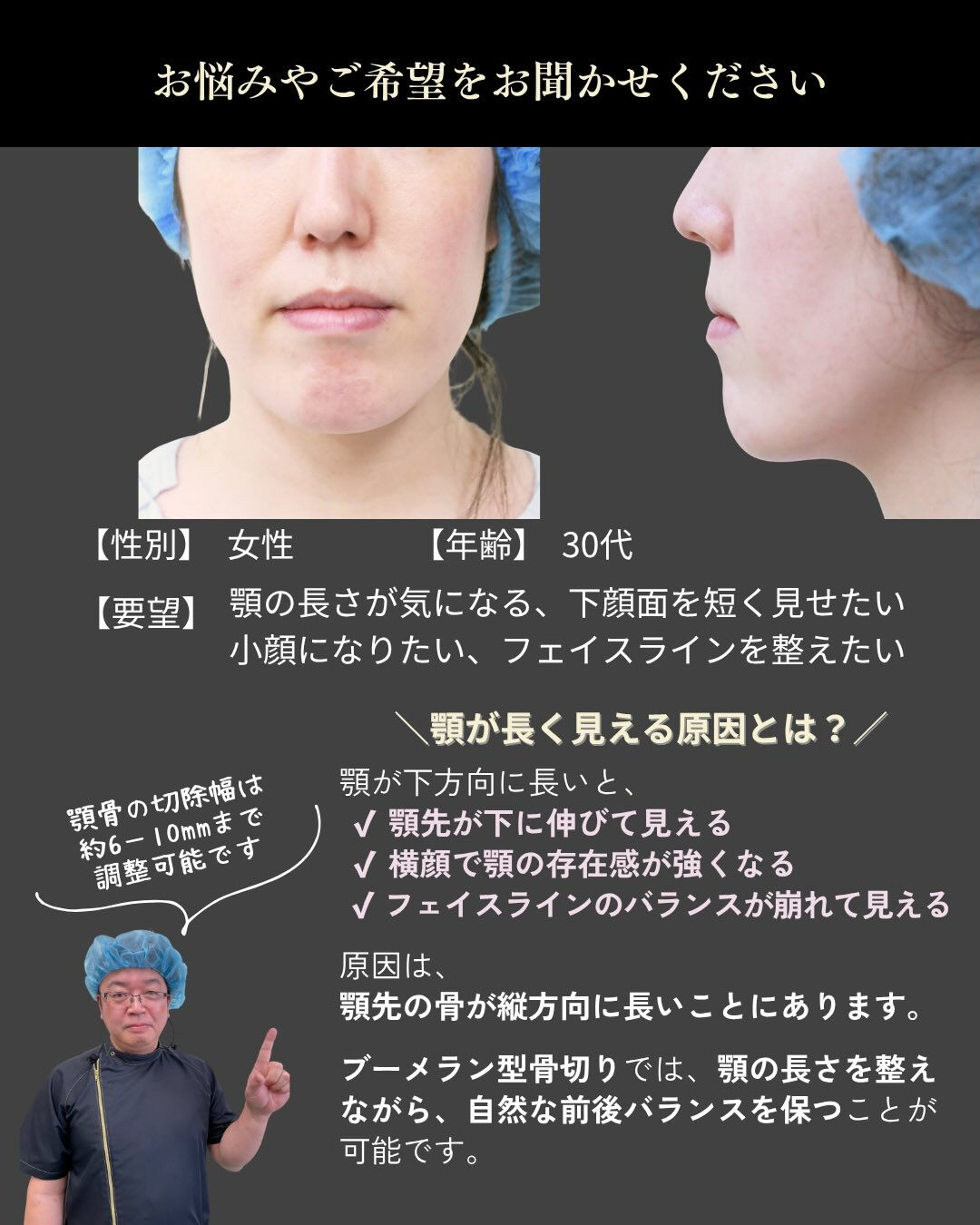 【下顎骨ブーメラン骨切り術 症例紹介】