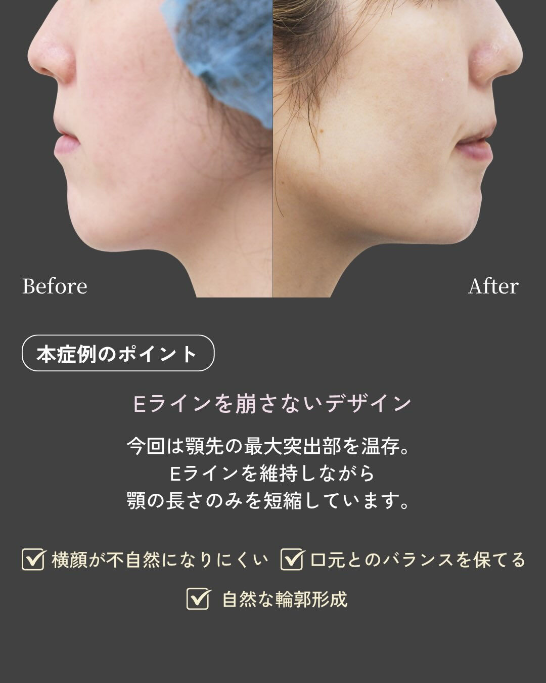 【下顎骨ブーメラン骨切り術 症例紹介】