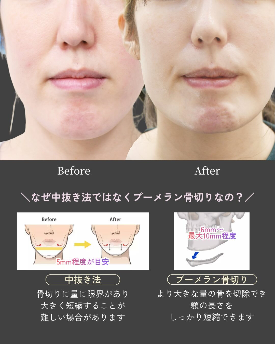 【下顎骨ブーメラン骨切り術 症例紹介】