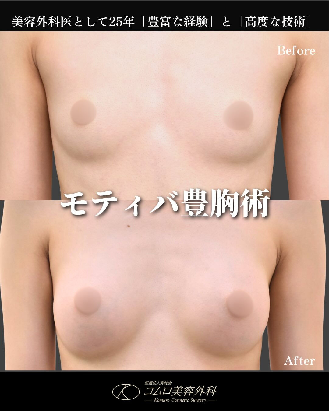 【モティバ豊胸症例】