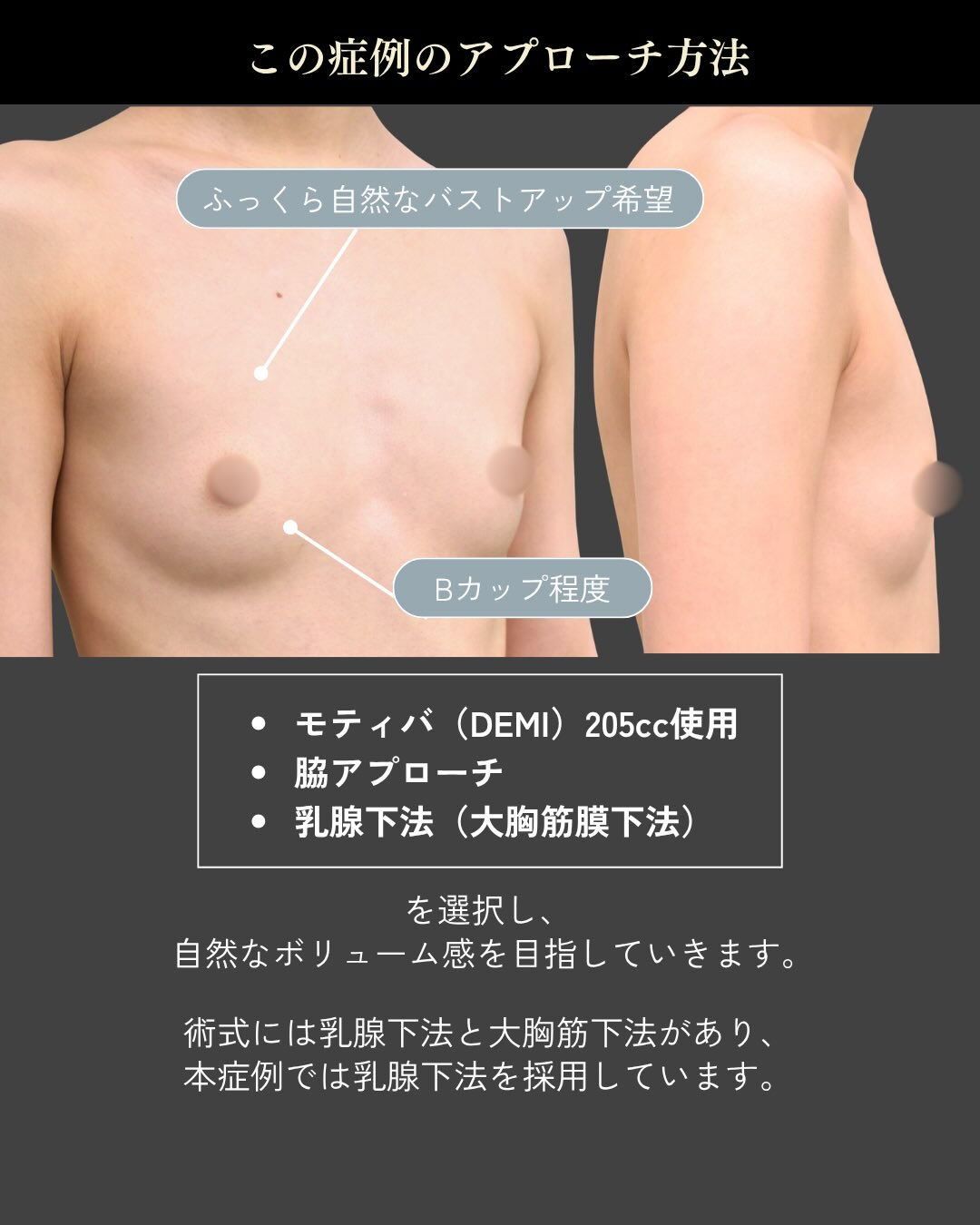 【モティバ豊胸症例】