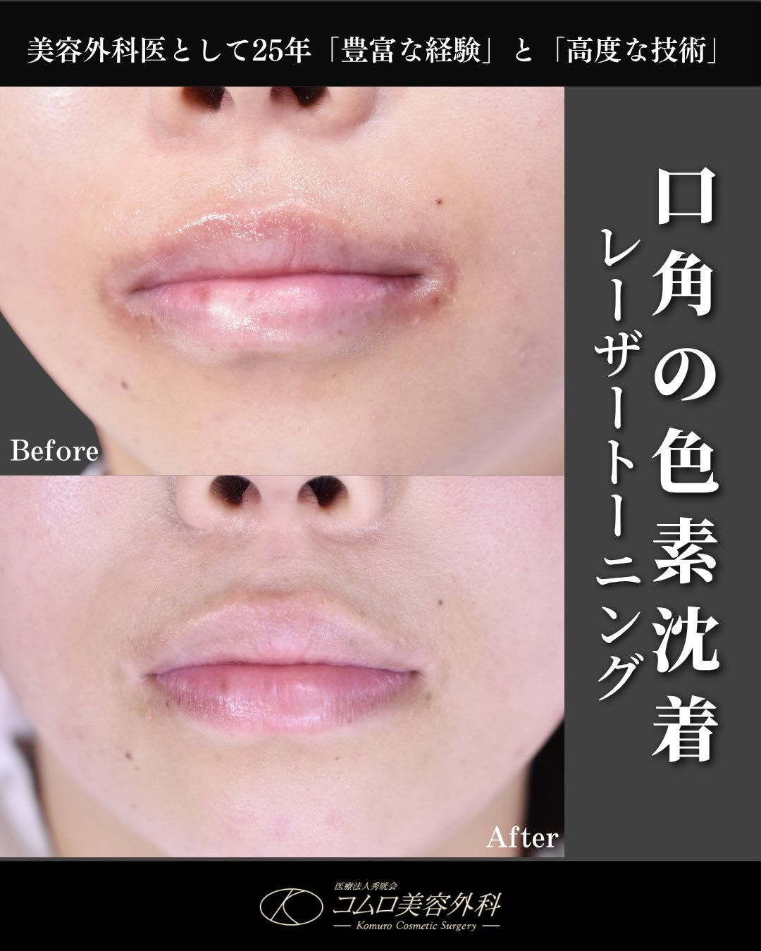 気になる口角の黒ずみ、あきらめていませんか？💋