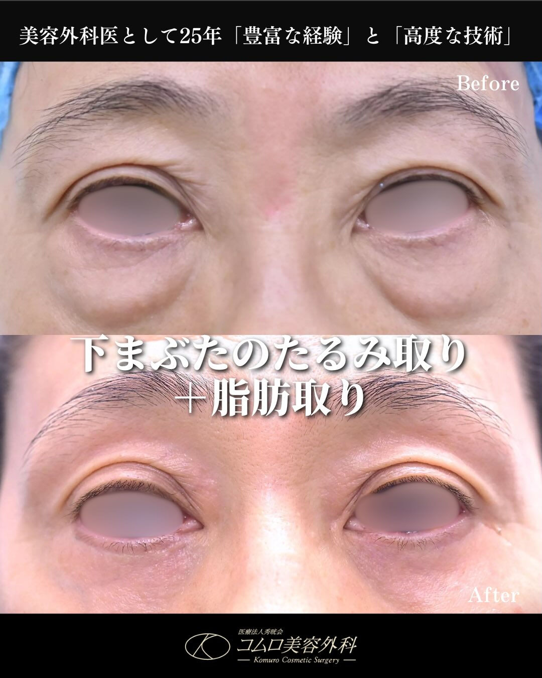 年齢とともに気になりやすい「下まぶたのたるみ・ふくらみ」